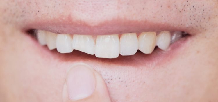 traumatismo dental rotura diente