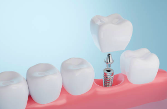implantes-dentales-con-poco-hueso