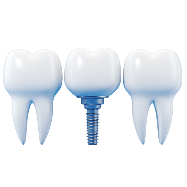 Implantología dental en Madrid: recupera tu sonrisa Implantología dental en Madrid: recupera tu sonrisa