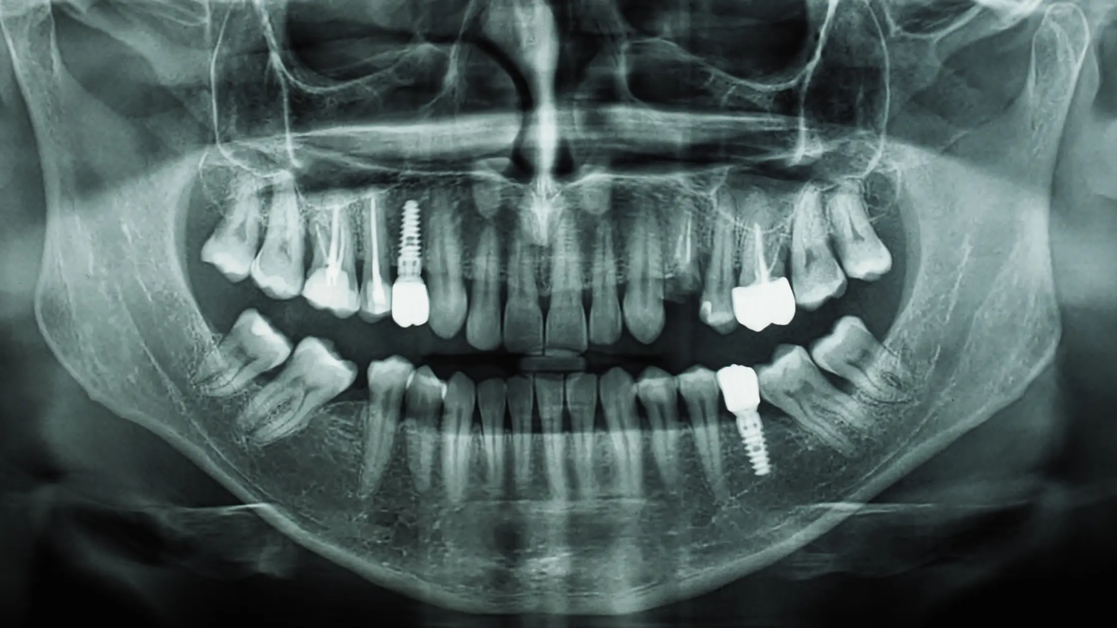 Rechazo implante: Radiografía panorámica con implantes dentales colocados en nuestras clinicas odontologicas