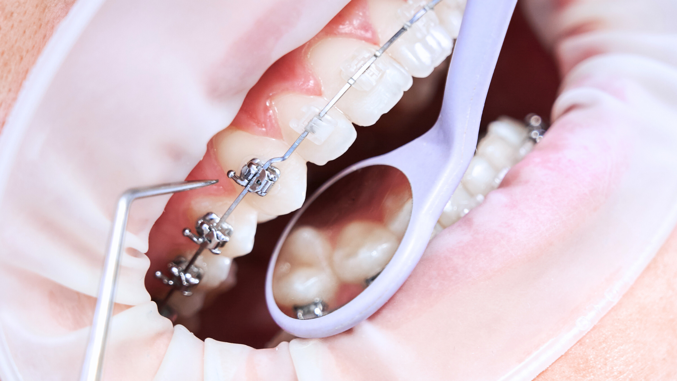 Ortodoncia con brackets siendo revisada por un instrumento dental