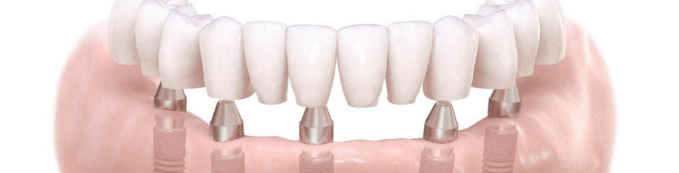 Representación gráfica de una prótesis dental fija de carga inmediata anclada sobre cuatro implantes de titanio en el maxilar
