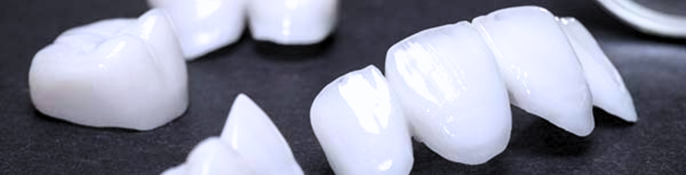 Set de carillas de porcelana terminadas con alta traslucidez y brillo natural antes de su cementación