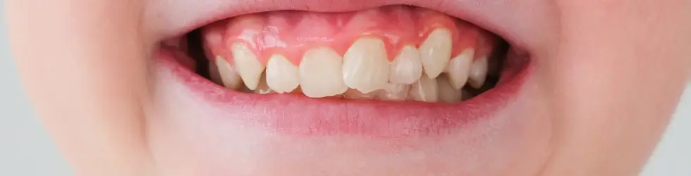 Caso de apiñamiento dental leve