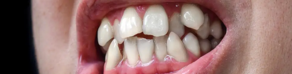 Caso de sobremordida moderada