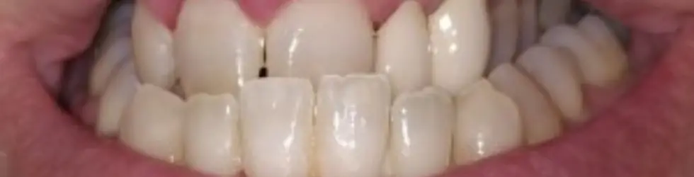 ¿Cuánto cuesta la ortodoncia invisible en Carabanchel? Precios y qué incluye el tratamiento? Caso de mordida cruzada bilateral