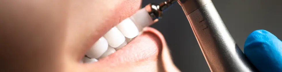 Aplicacion selladores de fisuras molar nino tratamiento preventivo dentista Vallecas