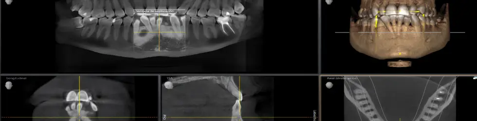 Tecnología CBCT TAC 3D para implantología dental en clínica de Carabanchel