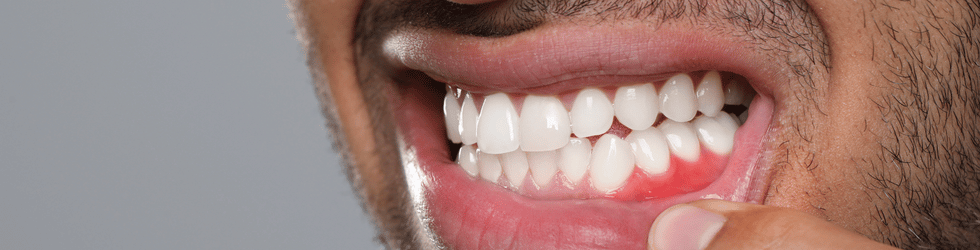 Revisión dental por sangrado de encías en Carabanchel Madrid en COPU