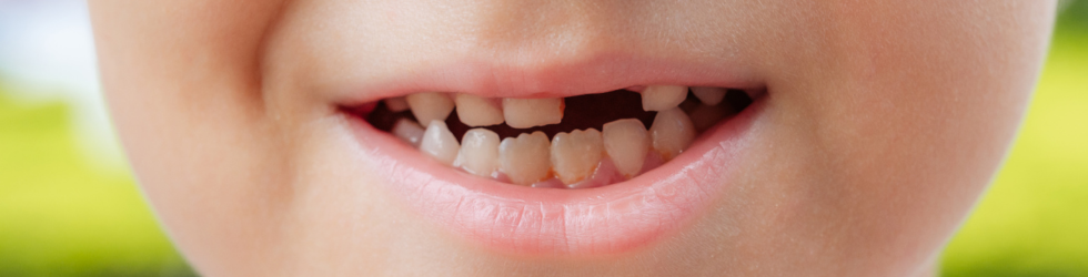 golpe-en-los-dientes-en-ninos