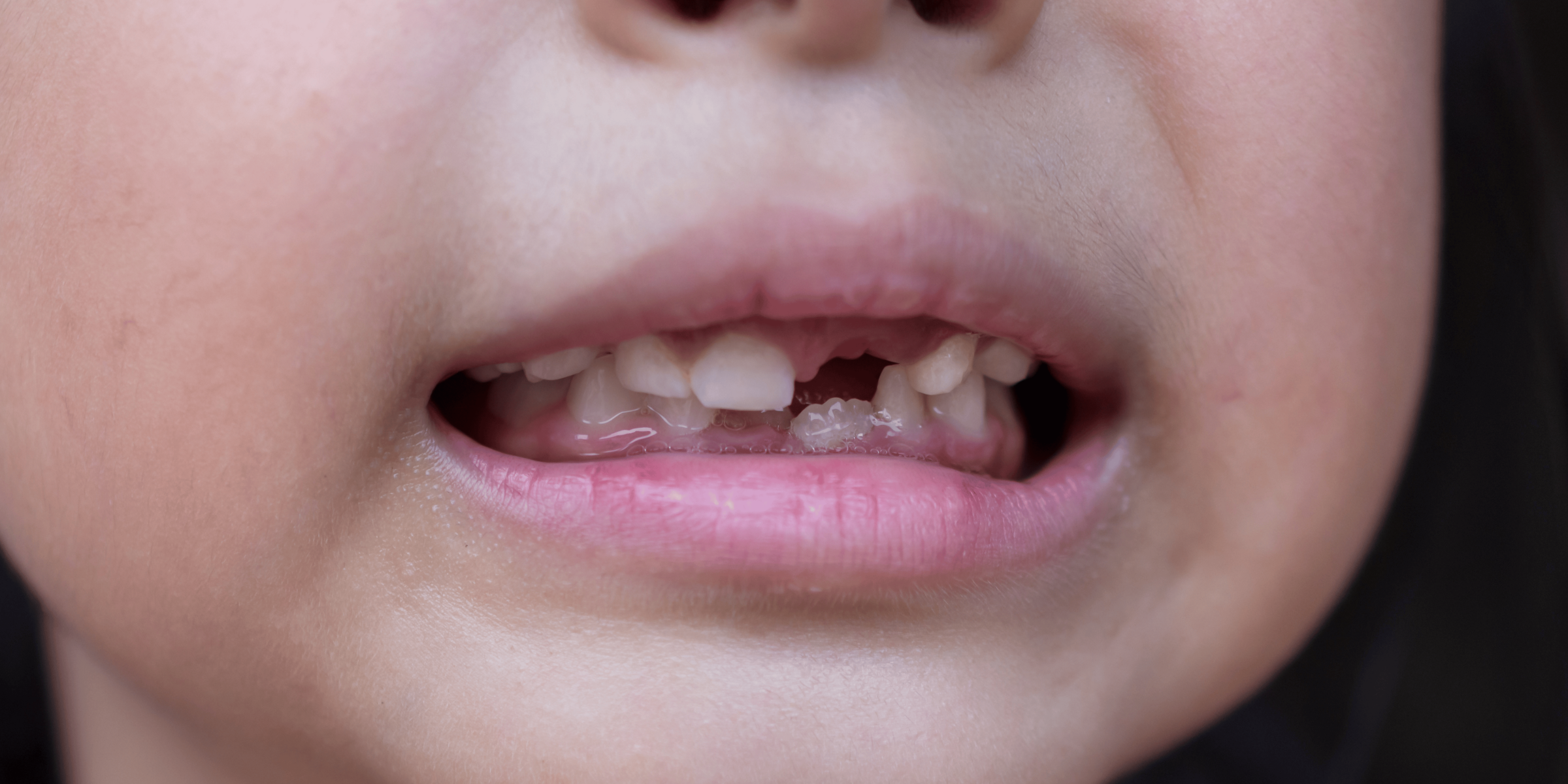 traumatismo-dental-en-ninos-carabanchel