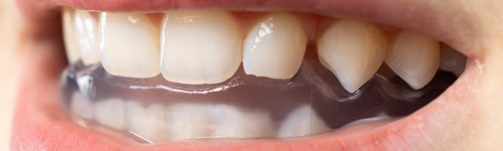 bruxismo en Vallecas