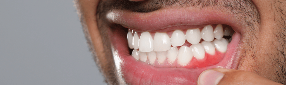 Revisión dental por sangrado de encías en Carabanchel Madrid en COPU