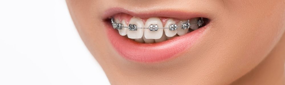 Beautiful young woman with teeth braces on gray