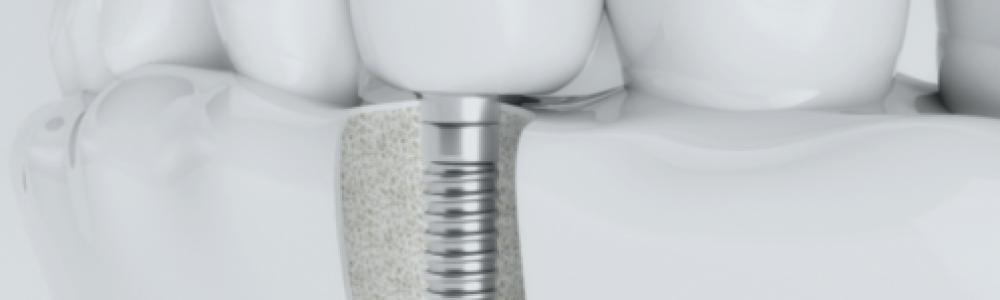 coste-implante-dental