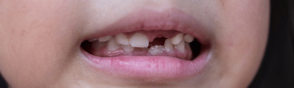 traumatismo-dental-en-ninos-carabanchel