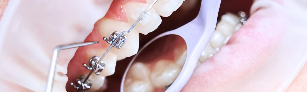 Ortodoncia con brackets siendo revisada por un instrumento dental