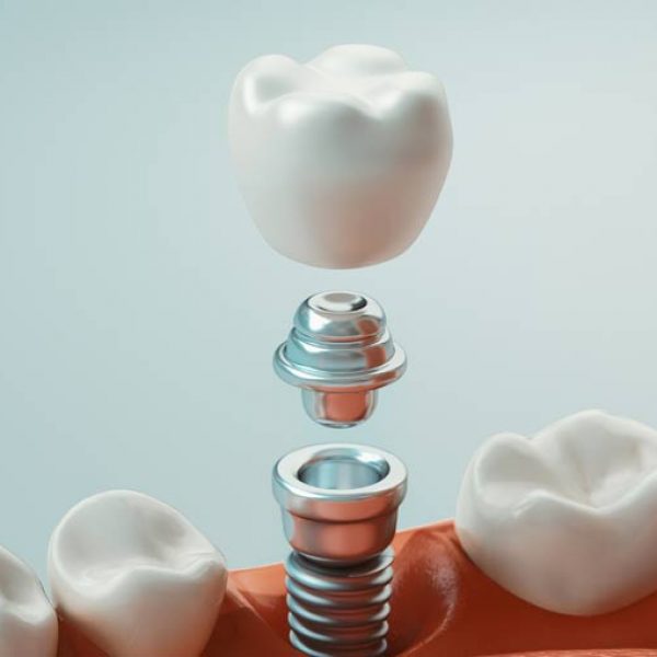 partes-implantes-dentales