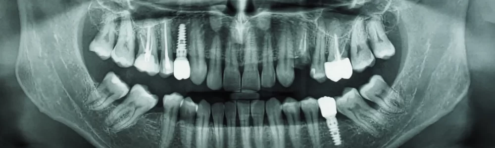 Rechazo implante: Radiografía panorámica con implantes dentales colocados en nuestras clinicas odontologicas